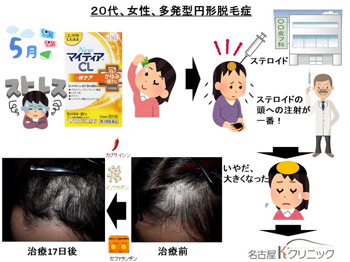 円形脱毛症　病院